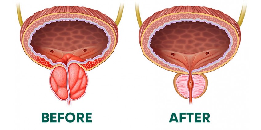 A Breakthrough in Prostate Care